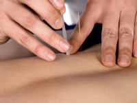 5 Benefits of Acupuncture