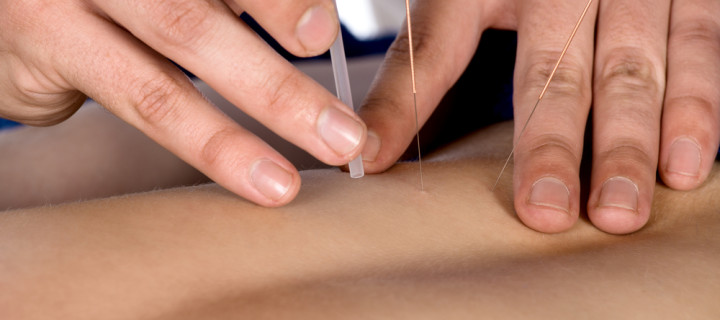5 Benefits of Acupuncture